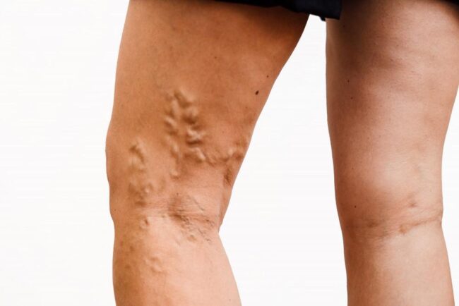 Varicose Veins Specialist Doctors in Hyderabad